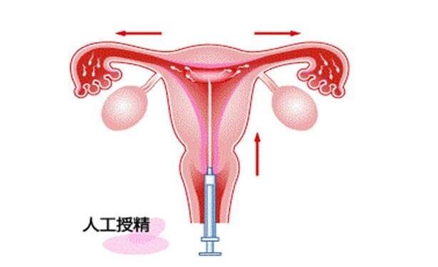 体外受孕