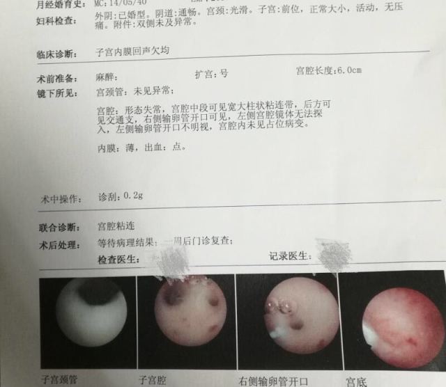 卵巢早衰借卵试管